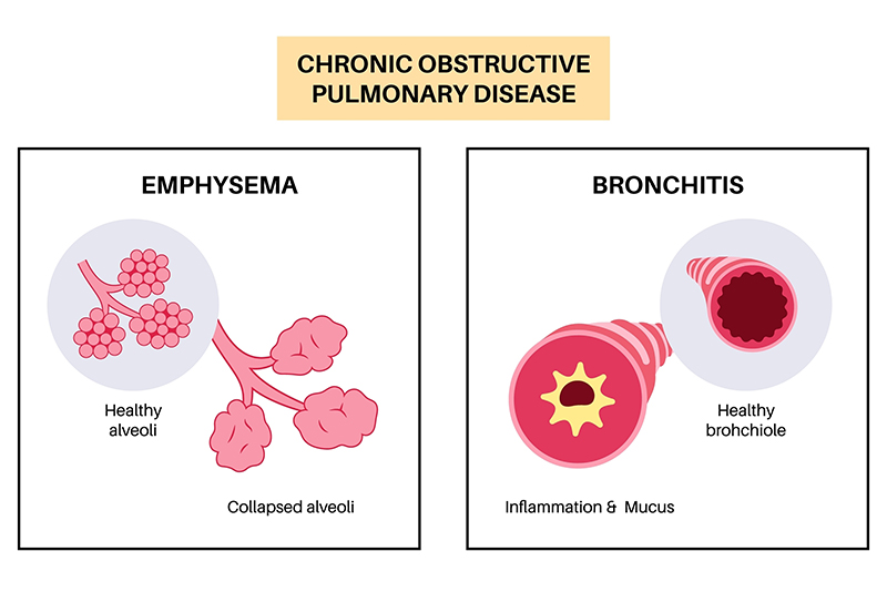 COPD